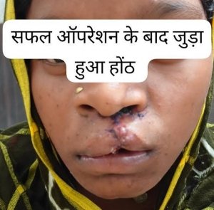 सफलता की कहानी :सफल सर्जरी से भीमे हेमला के चेहरे पर लौटी मुस्कान