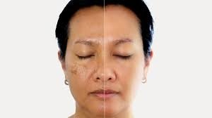 चेहरे पर दिखने वाली गहरी झाइयां भी इन फेस पैक्स से हो सकती हैं हल्की, घर में बनाकर ऐसे लगा सकते हैं ये पैक्स