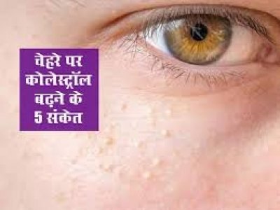 गंदा कॉलेस्ट्रोल बढ़ने से चेहरे पर नजर आ सकते हैं ये 5 लक्षण, समय रहते इस तरह कर लें पहचान